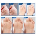 Foot Care Corn Remover Pads Effective Treatment for Corn and Calluses Foot Care Corn Remover Pads Effective Treatment for Corn and Calluses